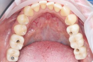zubny implantat - stolicky 2.jpeg