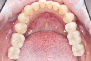 zubny implantat - stolicky 3.jpeg
