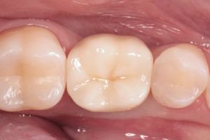 zubny implantat 3.JPG