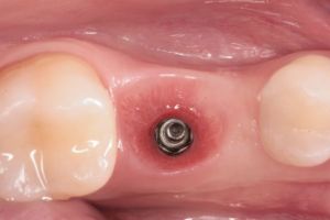 zubny implantat 1.JPG