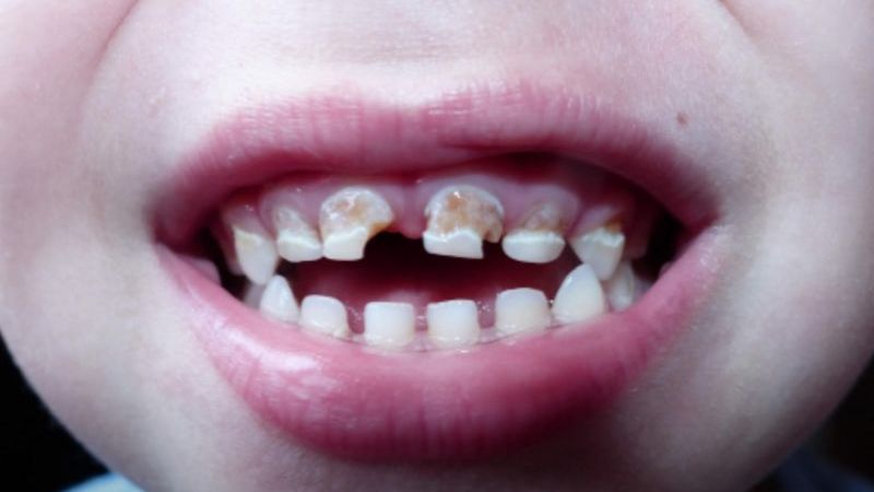 Medové zuby: fľaškový alebo cumlíkový kaz, obrázok