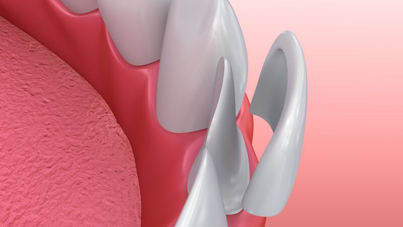 Estetické zubné fazety košice - obrázok