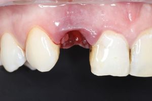 nahrada zuba implantatom 1.JPG