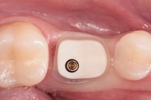 zubny implantat 2.JPG
