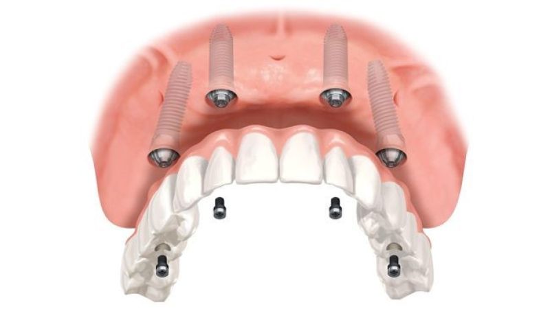 Zubný implantát košice - HappyDent
