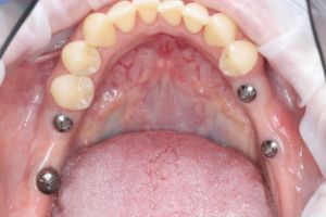 zubny implantat - stolicky 1.jpeg