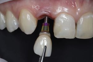 nahrada zuba implantatom 4.JPG