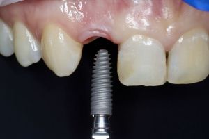 nahrada zuba implantatom 2.JPG