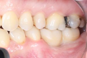 zubny implantat - stolicky 5.jpeg