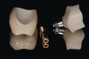 zubny implantat 5.JPG