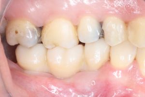 zubny implantat - stolicky 4.jpeg