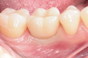 zubny implantat 4.JPG