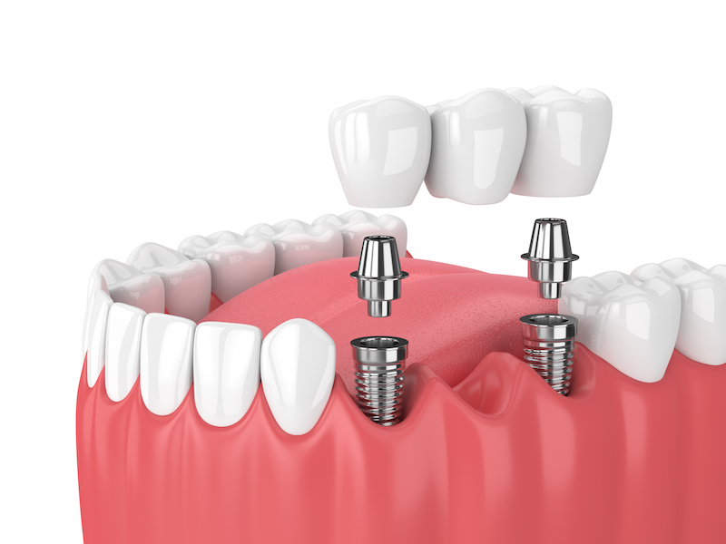 Zubný mostík - implantáty: HappyDent, obrázok