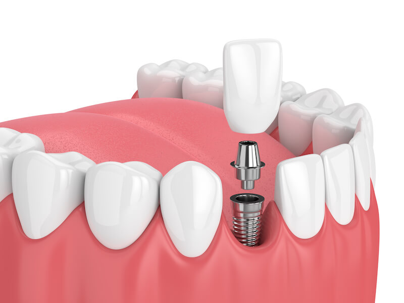 zubný implantát: HappyDent, obrázok