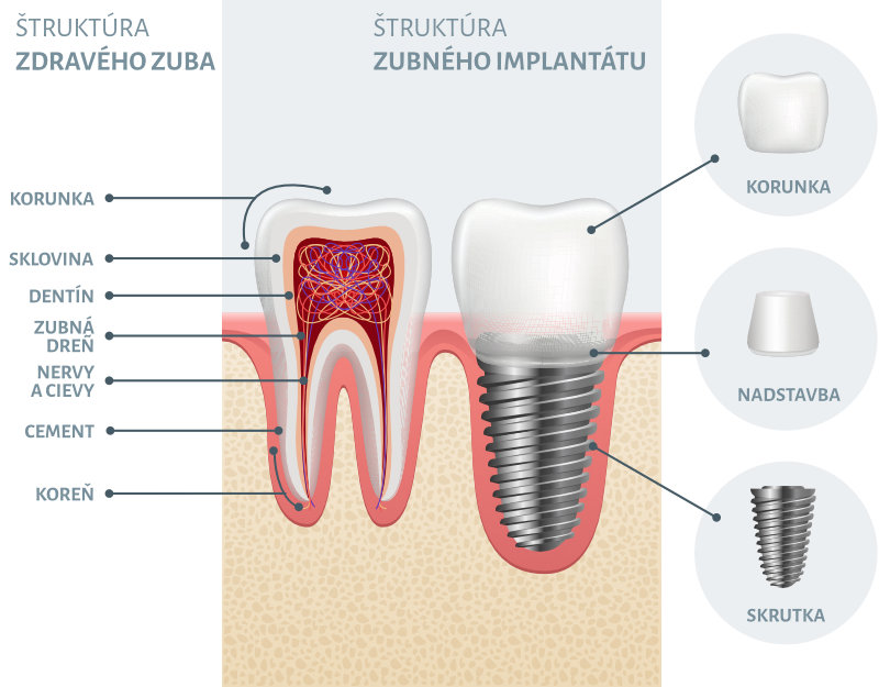 štruktúra zubného implantátu - HappyDent, obrázok