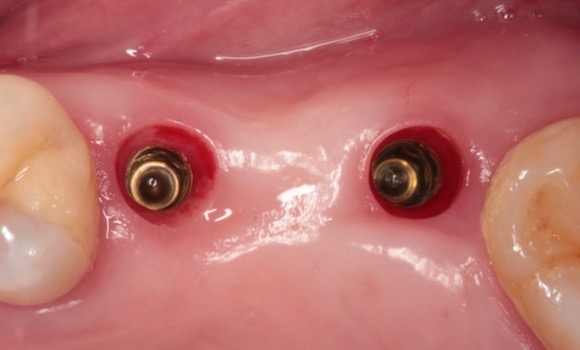 pred: kovokeramický mostík na implantátoch: zubar kosice