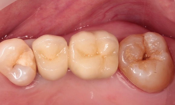 po: kovokeramický mostík na implantátoch: zubar kosice