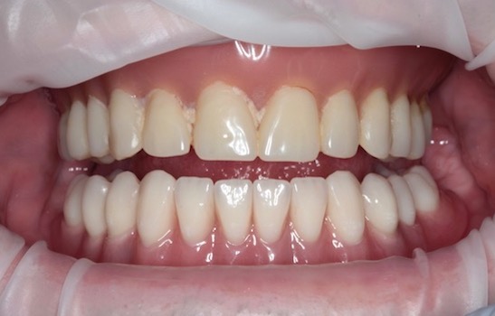 Zavedenie mini- implantátov - zubar kosice