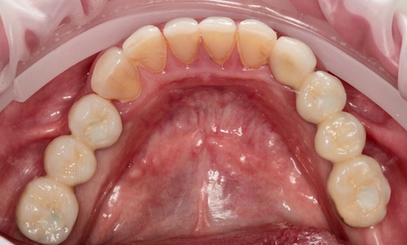 zavedenie implantátov - zubar kosice