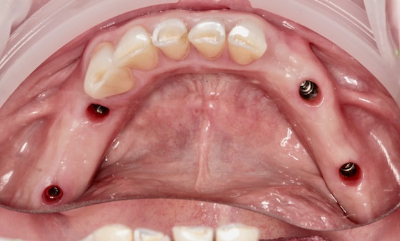 zavedenie implantátov - zubar kosice