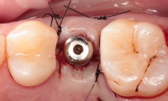 Príprava na zubnú implantáciu - zubar kosice