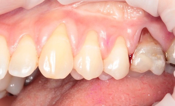 Zatvorenie recesov kŕčov zubov - zubar kosice