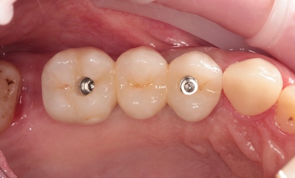 po: ZIRKÓNOVÝ MOSTÍK na implantátoch: zubar kosice