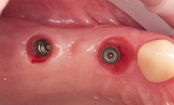 pred: ZIRKÓNOVÝ MOSTÍK na implantátoch: zubar kosice