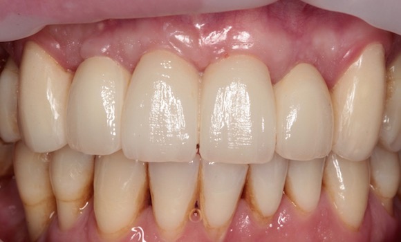 po: ZIRKÓNOVÝ MOSTÍK na implantátoch a zirkónové fazety: zubar kosice
