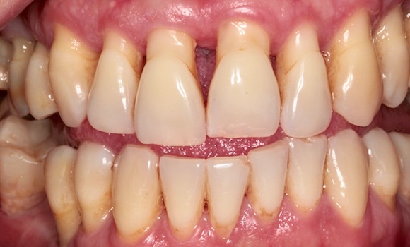 ZIRKÓNOVÝ MOSTÍK na implantátoch a zirkónové fazety: zubar kosice