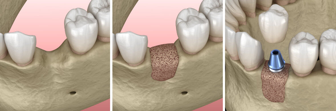 plastika celustnej kosti, obrázok Príprava na zubnú implantáciu: HappyDent, obrázok